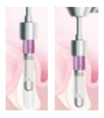Osadzenie implantu Tapered Screw-Vent