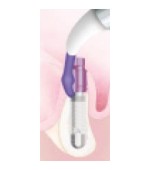 Osadzenie implantu Tapered Screw-Vent