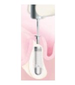 Osadzenie implantu Tapered Screw-Vent